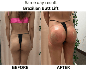 Ultra Smooth Cellulite Treatment Near Me in Encino, CA